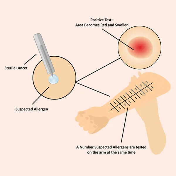 Skin-Prick-Test-1